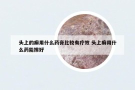 头上的癣用什么药膏比较有疗效 头上癣用什么药能擦好