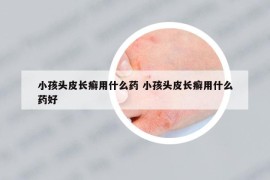 小孩头皮长癣用什么药 小孩头皮长癣用什么药好