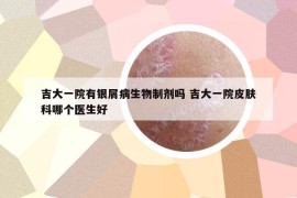 吉大一院有银屑病生物制剂吗 吉大一院皮肤科哪个医生好