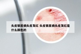 头皮银屑病头皮发红 头皮银屑病头皮发红是什么颜色的