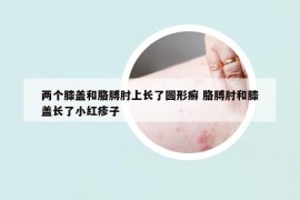 两个膝盖和胳膊肘上长了圆形癣 胳膊肘和膝盖长了小红疹子