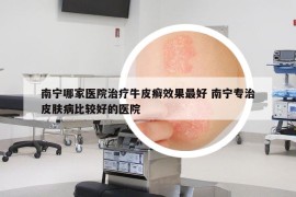 南宁哪家医院治疗牛皮癣效果最好 南宁专治皮肤病比较好的医院