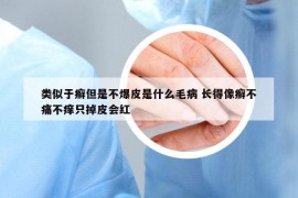 类似于癣但是不爆皮是什么毛病 长得像癣不痛不痒只掉皮会红