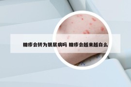 糠疹会转为银屑病吗 糠疹会越来越白么