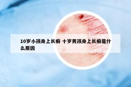 10岁小孩身上长癣 十岁男孩身上长癣是什么原因