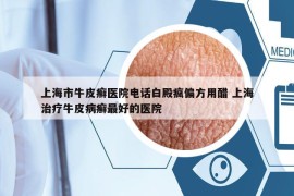 上海市牛皮癣医院电话白殿疯偏方用醋 上海治疗牛皮病癣最好的医院