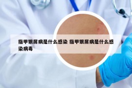 指甲银屑病是什么感染 指甲银屑病是什么感染病毒