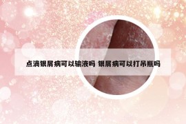 点滴银屑病可以输液吗 银屑病可以打吊瓶吗