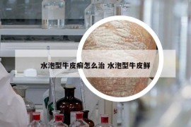 水泡型牛皮癣怎么治 水泡型牛皮鲜