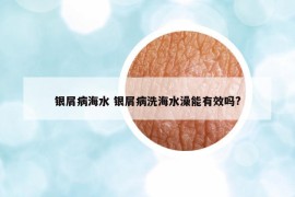 银屑病海水 银屑病洗海水澡能有效吗?