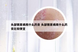 头部银屑病用什么药膏 头部银屑病用什么药膏比较便宜