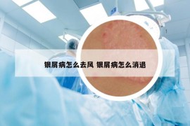 银屑病怎么去风 银屑病怎么消退