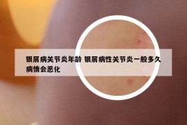 银屑病关节炎年龄 银屑病性关节炎一般多久病情会恶化