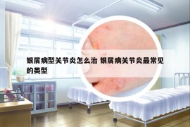 银屑病型关节炎怎么治 银屑病关节炎最常见的类型