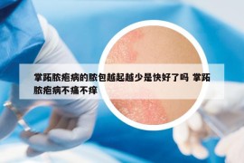 掌跖脓疱病的脓包越起越少是快好了吗 掌跖脓疱病不痛不痒