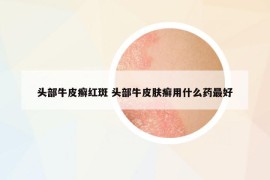 头部牛皮癣红斑 头部牛皮肤癣用什么药最好