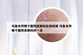 乌鲁木齐哪个医院皮肤科比较权威 乌鲁木齐哪个医院皮肤科好一点