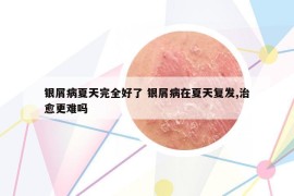 银屑病夏天完全好了 银屑病在夏天复发,治愈更难吗