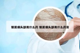 银屑病头部用什么药 银屑病头部用什么药膏