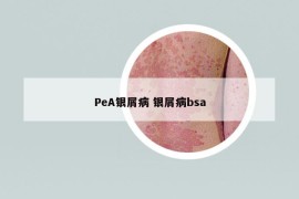 PeA银屑病 银屑病bsa