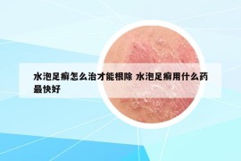 水泡足癣怎么治才能根除 水泡足癣用什么药最快好