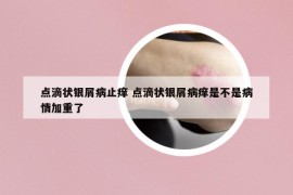 点滴状银屑病止痒 点滴状银屑病痒是不是病情加重了