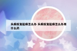 头癣反复起癣怎么办 头癣反复起癣怎么办用什么药