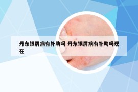 丹东银屑病有补助吗 丹东银屑病有补助吗现在