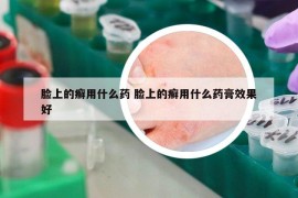 脸上的癣用什么药 脸上的癣用什么药膏效果好