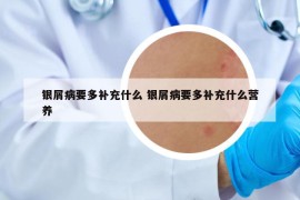 银屑病要多补充什么 银屑病要多补充什么营养