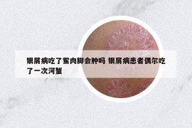 银屑病吃了鲎肉脚会肿吗 银屑病患者偶尔吃了一次河蟹