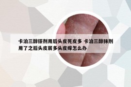 卡泊三醇搽剂用后头皮死皮多 卡泊三醇抹剂用了之后头皮屑多头皮痒怎么办