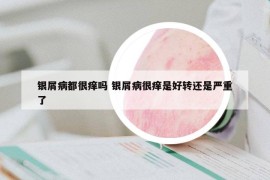 银屑病都很痒吗 银屑病很痒是好转还是严重了