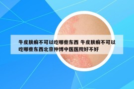 牛皮肤癣不可以吃哪些东西 牛皮肤癣不可以吃哪些东西北京仲博中医医院好不好