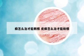 癣怎么治才能断根 皮癣怎么治才能除根