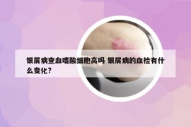 银屑病查血嗜酸细胞高吗 银屑病的血检有什么变化?