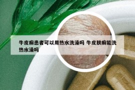 牛皮癣患者可以用热水洗澡吗 牛皮肤癣能洗热水澡吗