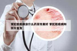 掌跎脓疱病涂什么药膏效果好 掌跎脓疱病如何不复发