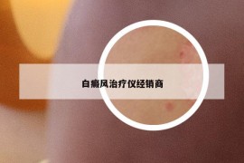 白癜风治疗仪经销商