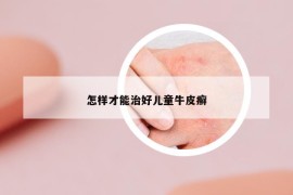 怎样才能治好儿童牛皮癣