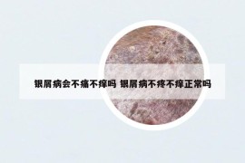 银屑病会不痛不痒吗 银屑病不疼不痒正常吗