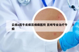 云南a昆牛皮癣百病癜医院 昆明专业治疗牛癣