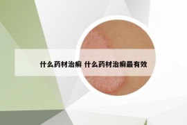 什么药材治癣 什么药材治癣最有效