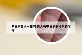 牛皮癣男人可怕吗 男人有牛皮病癣可以怀孕吗