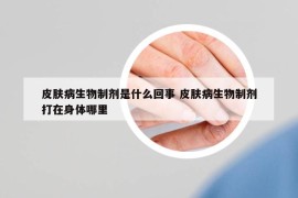 皮肤病生物制剂是什么回事 皮肤病生物制剂打在身体哪里