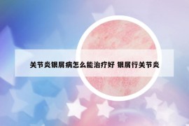 关节炎银屑病怎么能治疗好 银屑行关节炎