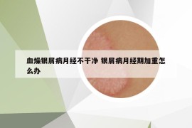 血燥银屑病月经不干净 银屑病月经期加重怎么办