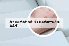 患有银屑病如何治疗 得了银屑病有什么方法治愈吗?