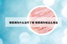 银屑病为什么治不了根 银屑病为啥这么难治