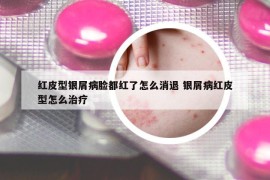 红皮型银屑病脸都红了怎么消退 银屑病红皮型怎么治疗